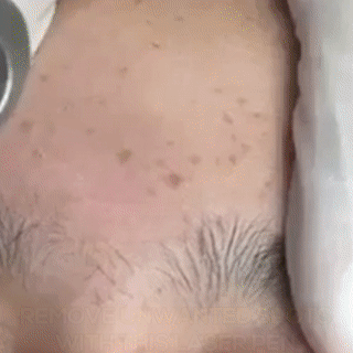 Clear Skin Laser Pen