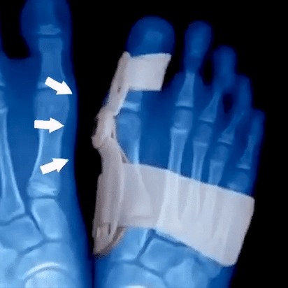 HappyToes Bunion Relief Straps
