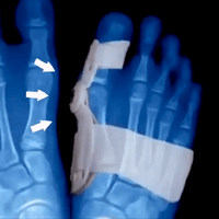 HappyToes Bunion Relief Straps